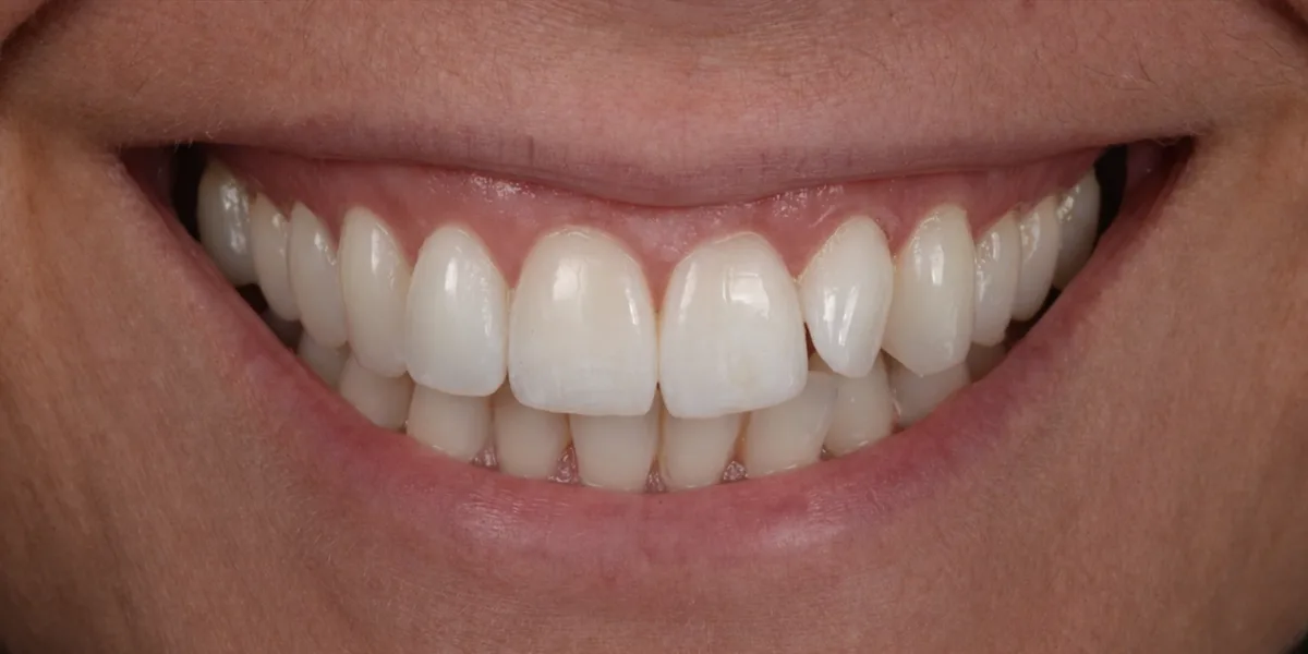 Smile 1, after treatment with Dr Lia