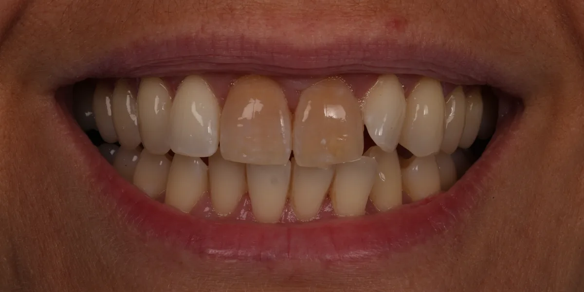 Smile 1, before treatment with Dr Lia