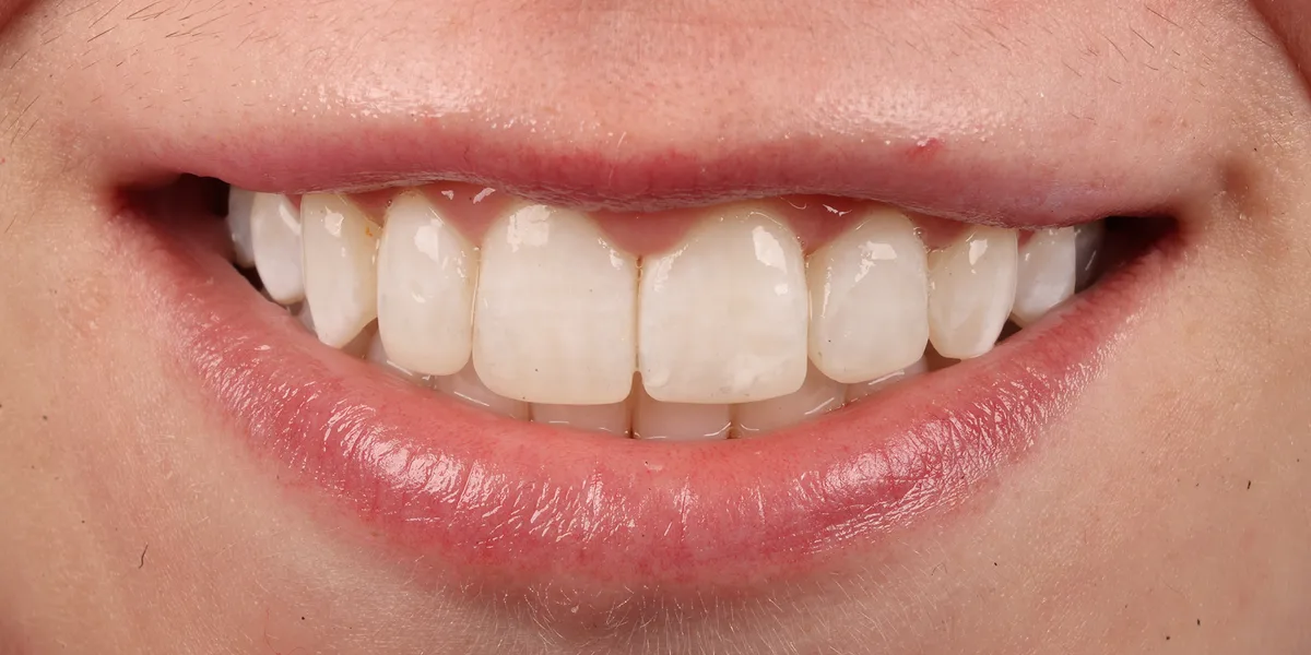 Smile 2, after treatment with Dr Lia