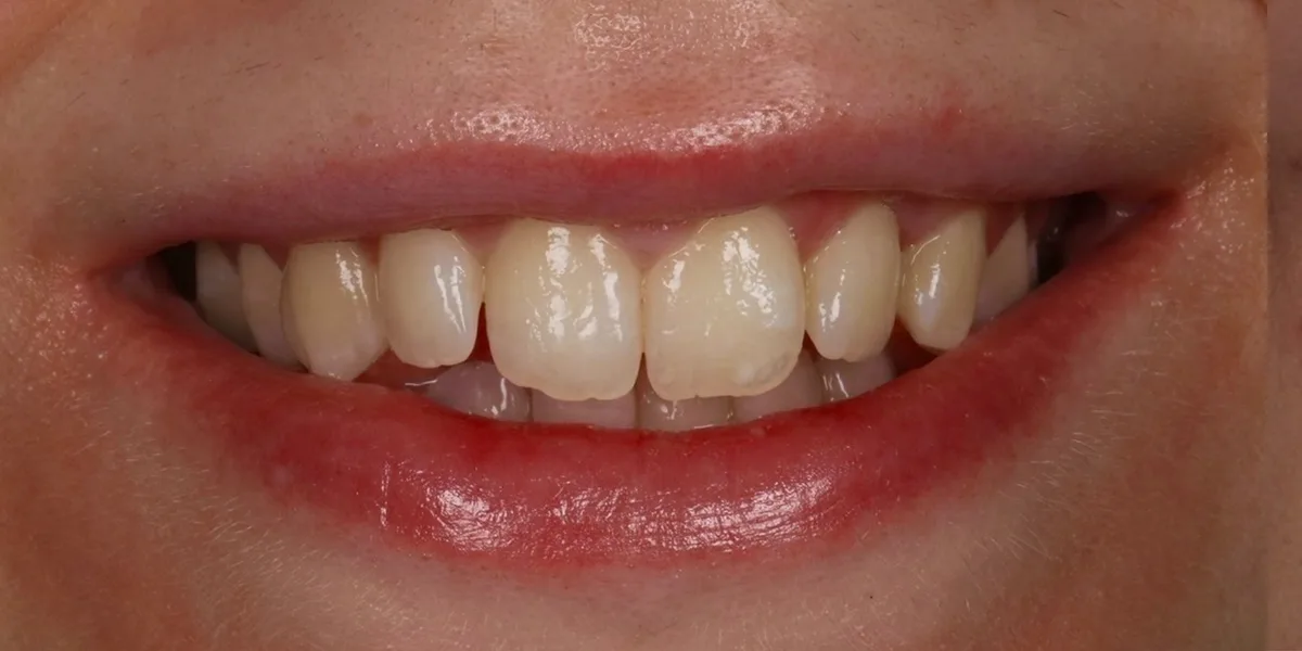 Smile 2, before treatment with Dr Lia