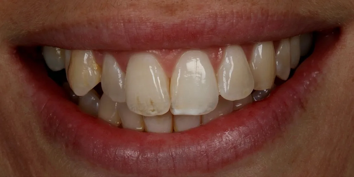 Smile 3, before treatment with Dr Lia