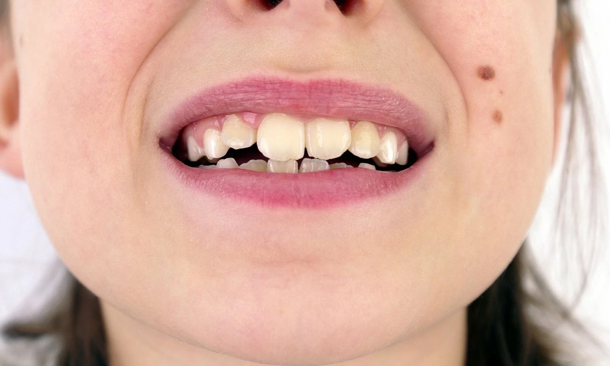 Composite Bonding Dentist Near You 5 file slightly crooked | Pearly Whites London