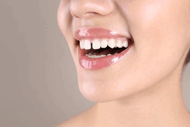 Composite Bonding Dentist Near You 2 file teeth gaps | Pearly Whites London