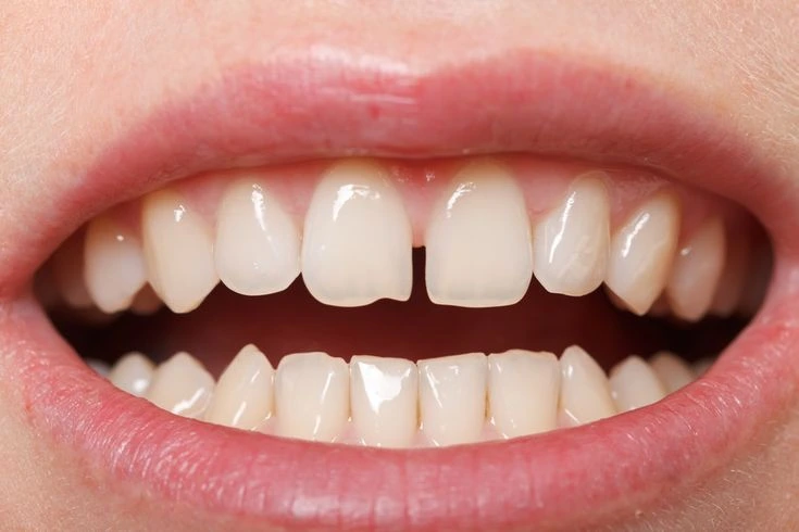 Composite Bonding Dentist Near You 4 file worn teeth | Pearly Whites London